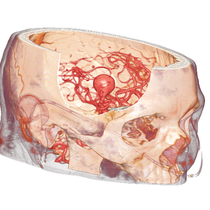 image brainAnuerysmC00.png 